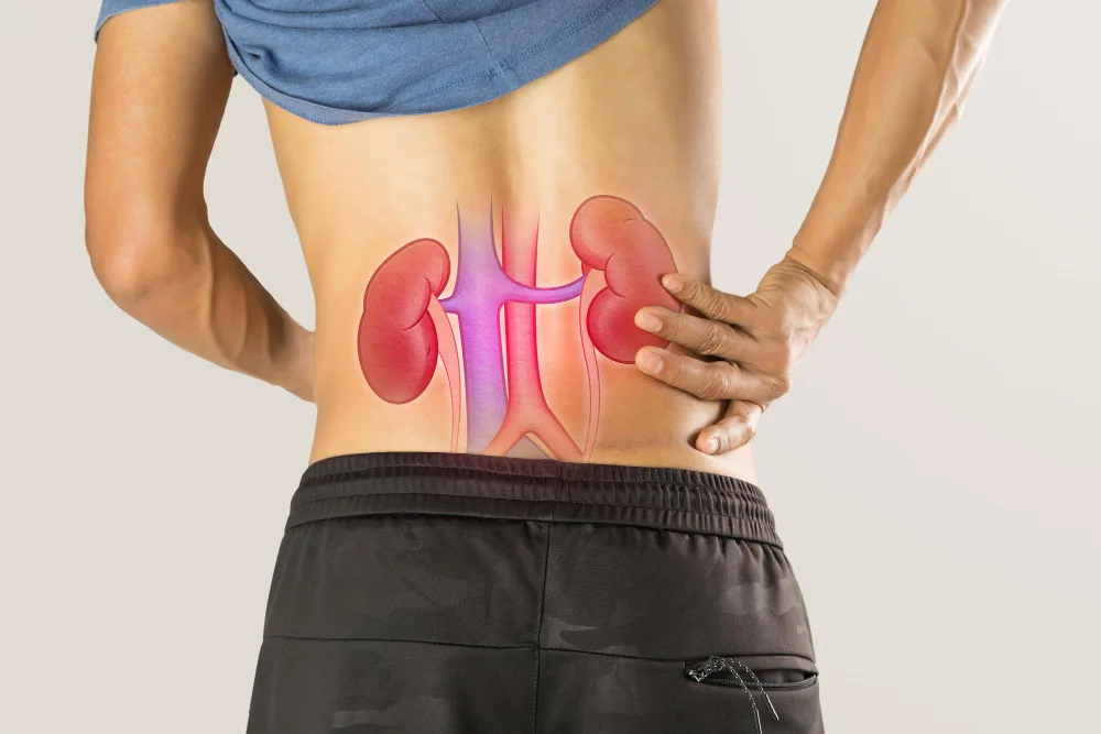Litiasis urinaria en CDMX